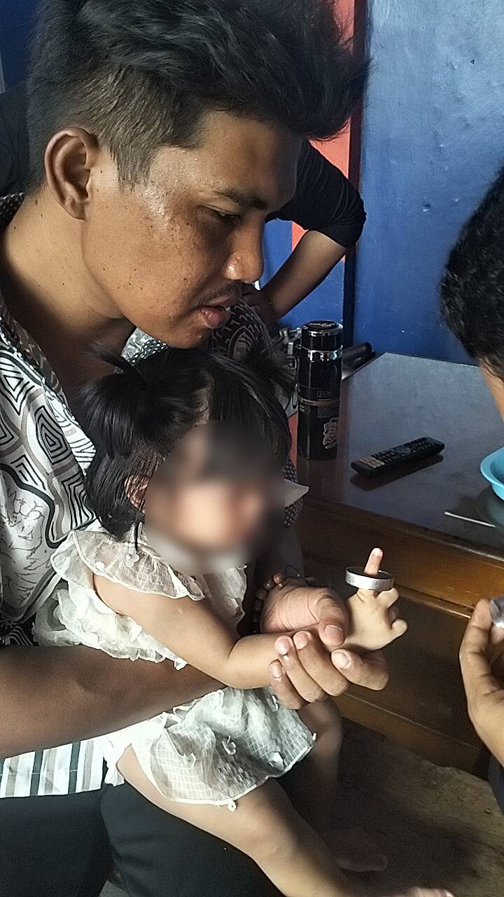 TERSANGKUT BENDA: Kondisi benda bulat yang terbuat dari seng dan tersangkut pada jari balita. Beruntung BPBD Kota Tangerang UPT Damkar dan Penyelamatan Ciledug turun tangan. ISTIMEWA