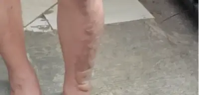 Korban penyiraman air keras. Foto : Ist